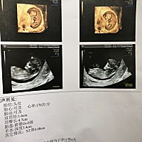 11周多，今天做的Nt。宝宝看起来很好，很乖。