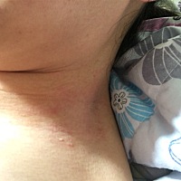 脖子上起了一圈皮疹，去看了皮肤科说是神经性皮炎，我平时365天基本都出，抹点药能缓解好多，现在不敢擦...