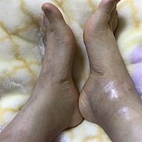 腿肿得很厉害 去医院检查叫卧床休息 但还是很肿 有没有像我这样的宝妈吗