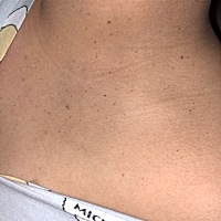 怀孕后脖子上长了好多好多这种小肉粒。。怎么回事？有治疗的办法吗？宝妈们