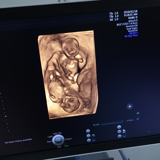 12周➕3天。nt检查