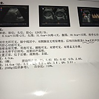 一直担心脑积水 可现在都九个月了 很怕