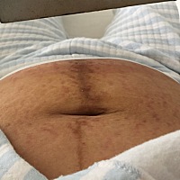 怀孕期间一定要认真对待妊辰纹，能摸的都要试试！千万别像我一样，怀孕前肚皮比较紧，怀孕六个多月开始...