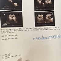 今天孕8周复查了，宫腔偏左靠近宫角，有宝妈相识的吗？医生说要么流，要么观察一周后复查，如果胚胎不移...