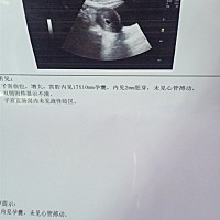 怀孕51天查的结果，实际B超天数医生说只有42天，不知道正常不！前几天玩的累了有一点点的粉色血，不知道...