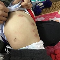 宝宝一岁了，身上长这东西，长特别多，晚上睡觉又痒抓破皮，去医院医生说是湿疹开了药也不见好，怎么办...