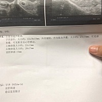 末次1.4 今天bc出来有盆腔积液 有一样的吗