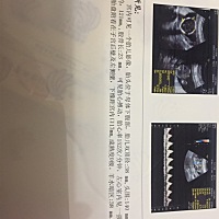 左心室有个强光点，对宝宝有没有影响