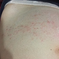 怀孕三个月，肚子很痒，有点起疹子，是怎么回事呢？