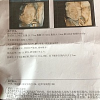我的三张彩超报告麻烦各位懂得帮我看看是男宝宝还是女宝宝，还有一个月预产期