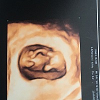 怀孕12周，可以看出男宝女宝吗？