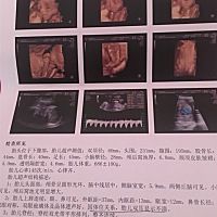 昨天去做的四维，挺顺利的，能看的出男孩女孩吗？