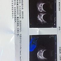 有没有不知道怀孕了喝啤酒和红酒了，有没有影响，还吃过两次药，现在特别害怕