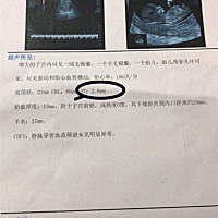 怀孕13wod做的比超NT2.6大家帮我看一下比超单是否正常，能看出，性别吗？