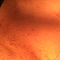 孕妇湿疹 有什么有效的方法或者药物