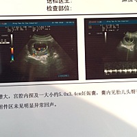 今天第一次做b超，医生说宝宝已经开始长胳膊腿了。两个月，有一样的妈妈吗？