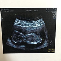 有宝妈可以通过ＮＴ图看男女的吗好奇，男女都要