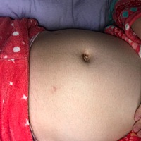 双胞胎18周平躺的肚子是不是很小呢