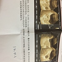 末次月经1.4号，21号去医院确定了怀孕，但是未有胎心胎芽，到现在为止，除了胸部有点涨，其他反应都没有...
