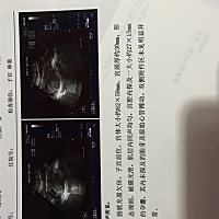 愁人啊，我可能停孕了，第一次查没胎芽胎心，第二次查有胎芽无胎心，我真无语了