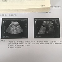 7➕1今天做B超有胎心胎芽了，各位大神这个时候就能看出男女吗？帮忙看看呀