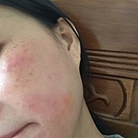 孕期经常过敏的都用什么弄好了啊？