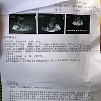 B超只找到屁屁。。谁能帮我看看 宝宝发育情况好吗？ 女宝的可能性大吗？想要女孩儿😳😳