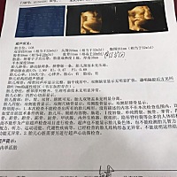 有怀孕32周做B超发现宝宝透明隔腔有6.1mm液性暗区的吗  35周去又变成6.2mm了 有影响吗