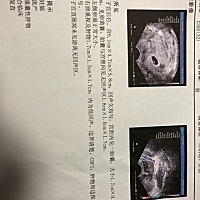 最后一次例假1月11号来的 正常排卵期在雪月底 前两天去查 本来想查孕酮指数等 一进去医生就让我查彩超和...