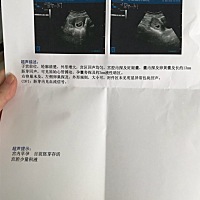 忘了附图，这孕囊是女宝吧