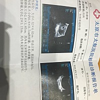 今天去做b超 四十多天孕囊小 还没看到胎心，会不会有什么事啊，有和我一样情况的宝妈么