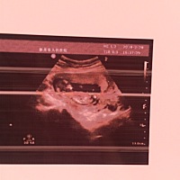 有没有懂看B超单的？12W帮看下男女