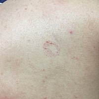 后背有个这个，怀孕的老婆因为这个吵得不可开交，这个看起来很像草莓印吗