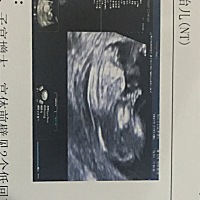 12周nt1.4 ，男还是女？