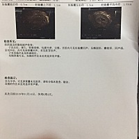 6周5天了，这两天有褐红色分泌物，有点像月经末期，量很少，照过B超，医生给我开了些安胎药，有情况相同...