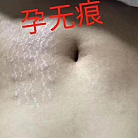 妊娠纹、肥胖纹、斑点、黑色素、胎记、黑痣、扁平疣这些问题统统搞定，签约制度，无效退款！加盟免费技...