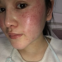 有没有妈妈和我一样，脸上长痘子，发痒，难受，会不会一直到生啊？有没有怀孕的宝妈生了之后好了的？