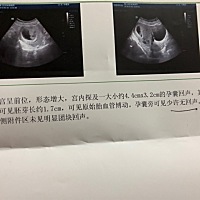 今天去医院检查，照B超。有8周了！但是医生说我们这个胎儿的卵黄囊不圆润，有点扁，我怕胎儿有影响，怕...