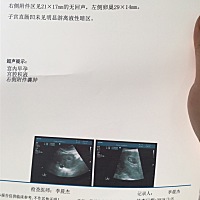 能不能告诉我我这个没有什么事吧！今天医生告诉我，有可能不好