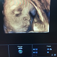 我宝宝的四维照片，哈哈，给大家分享，一下，孕妈可以分享下，待产包么，现在在纠结，到底顺产好，还是...