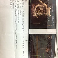 还有一个多礼拜就生了，这是现在的肚子和之前的b超四维彩超，看得出是男孩还是女孩吗？很好奇啊。