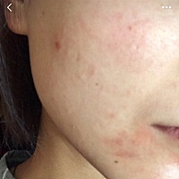 我的脸真的是沙漠干皮➕反复过敏性肌肤 对海鲜 毛絮 胶带 花粉 过敏，因为角质层太过薄弱，特别是冬天吹...