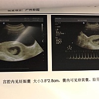 孕8周五天的bc 大家帮忙看看男女 有点好奇😳