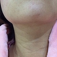 有没有怀孕期间长颈纹的，怎样才能消淡……