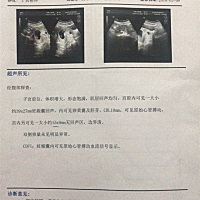 医生说应该是双胞胎！求大家帮忙看看