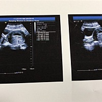 听说胎囊就能看出男娃女娃，是真的不？