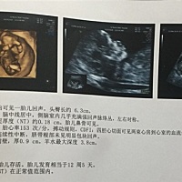 亲们，这个是我的NT检查，请问有没有哪位孕妈分的清怀的是男宝还是女宝呀！