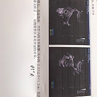 1月10号末史月经，没有胎心和卵黄囊.医生问要不要...我很担心