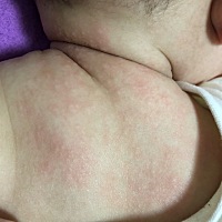 有没有宝妈，知道这是什么情况？是过敏吗？