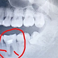 昨天拔智齿拍片发现，10来年前补的牙齿，根部有点发炎，医生说是牙槽骨骨质被破坏了，需要做根管治疗。...